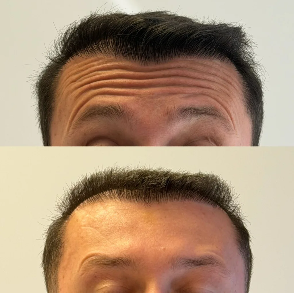 Antes e depois de toxina botulínica no terço superior: acima, linhas de expressão marcadas na testa; abaixo, a pele lisa