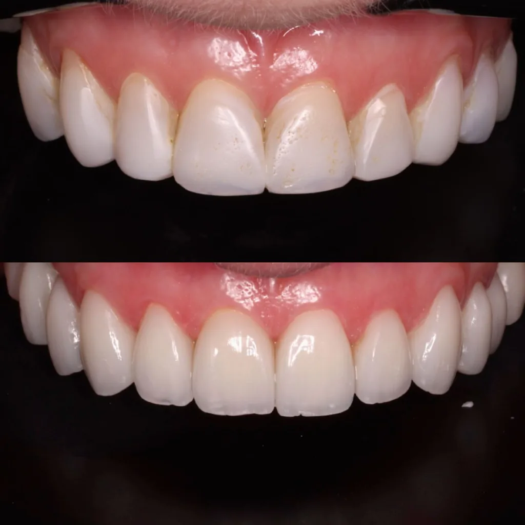 Antes e depois de facetas de porcelana em vista intraoral aproximada, sem identificação da paciente