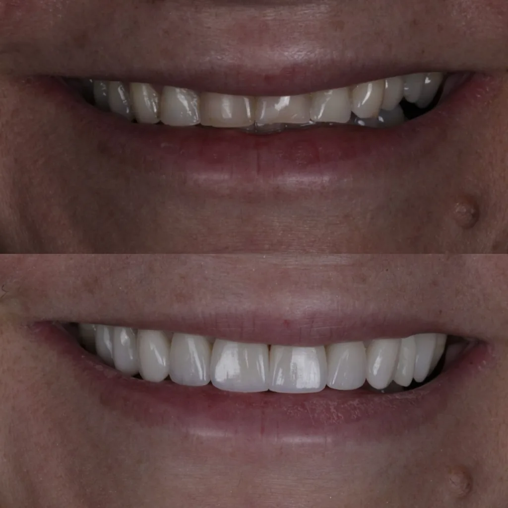 Antes e depois de facetas de porcelana: acima, dentes com alteração de cor, bordas desgastadas e espaços; abaixo, o resultado após a cimentação