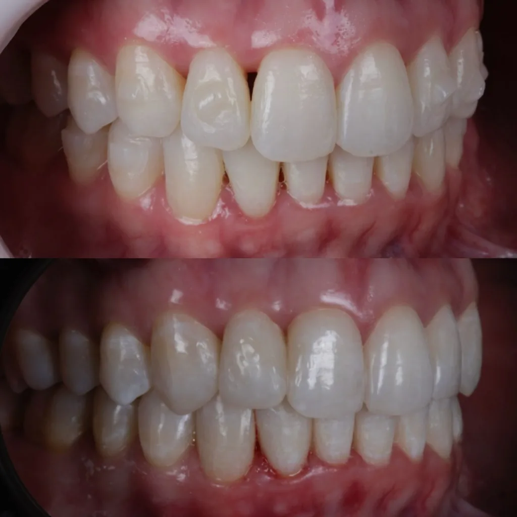 Antes e depois de facetas de resina em vista intraoral aproximada, sem identificação da paciente