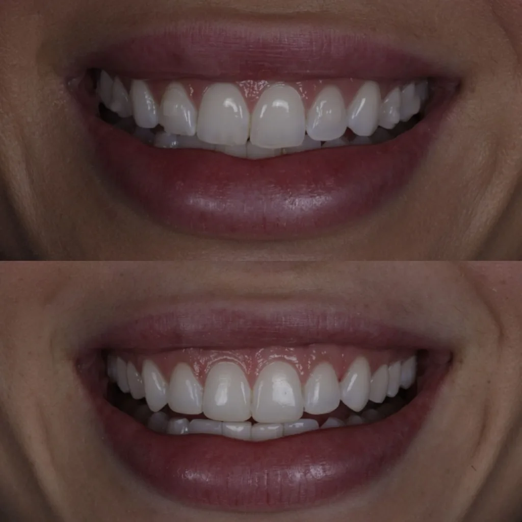 Antes e depois de facetas de resina: acima, bordas desgastadas e espaço entre os dentes; abaixo, o resultado
