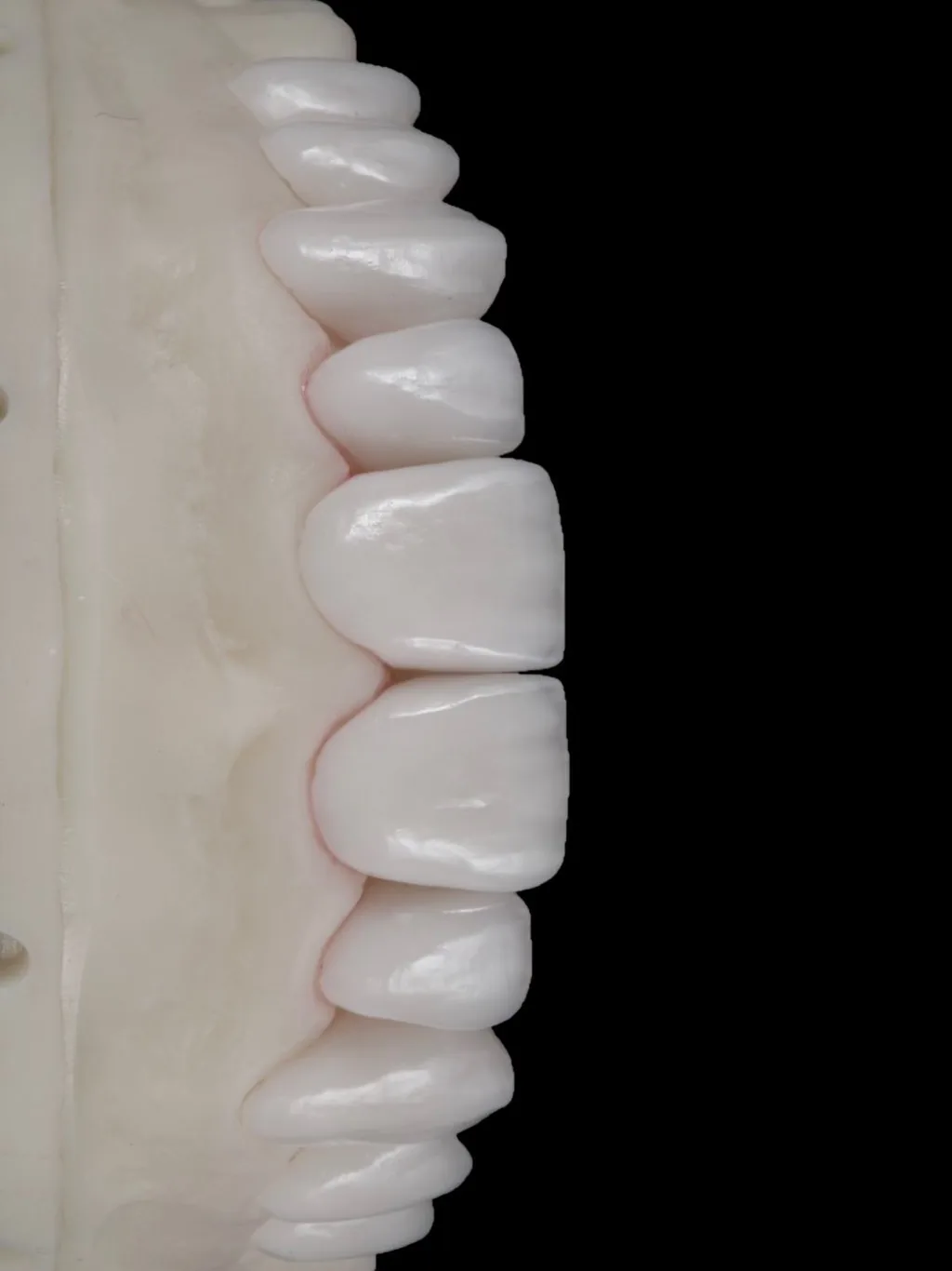 Facetas de porcelana sobre modelo, vistas de frente